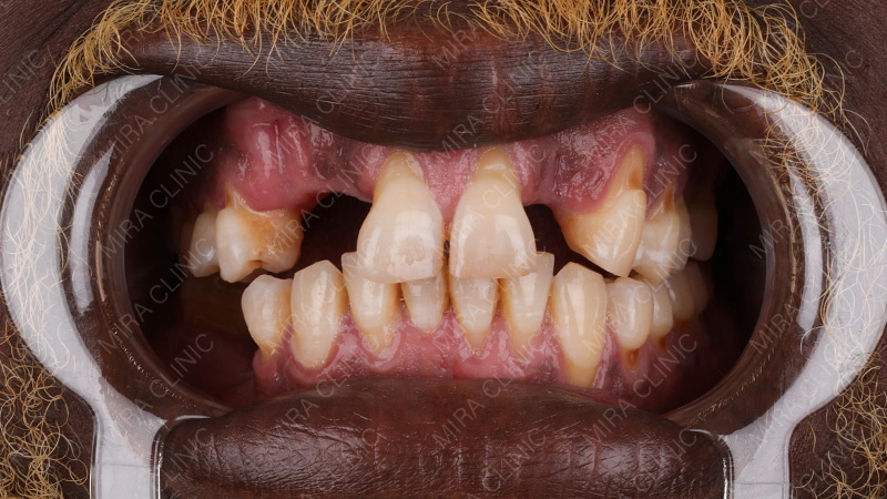 Cracked Teeth patient experience 